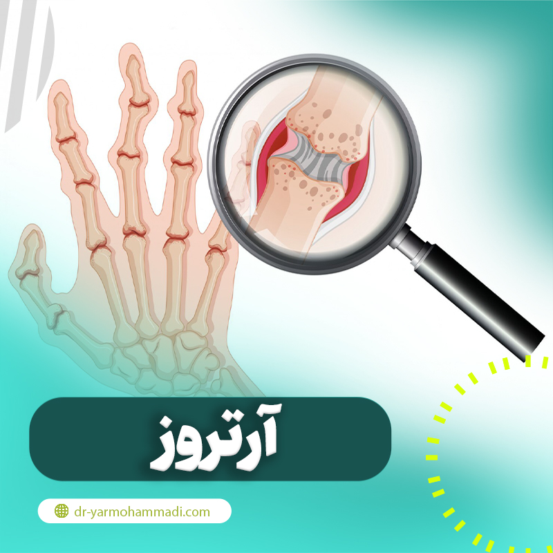 آرتروز چیست؟