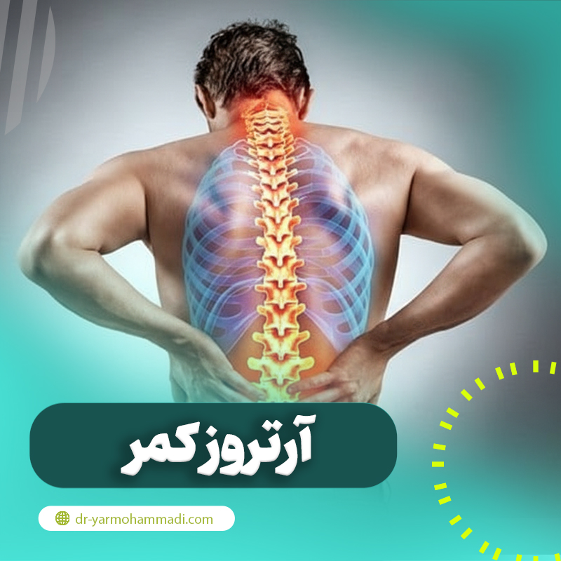 آرتروز کمر و ستون فقرات