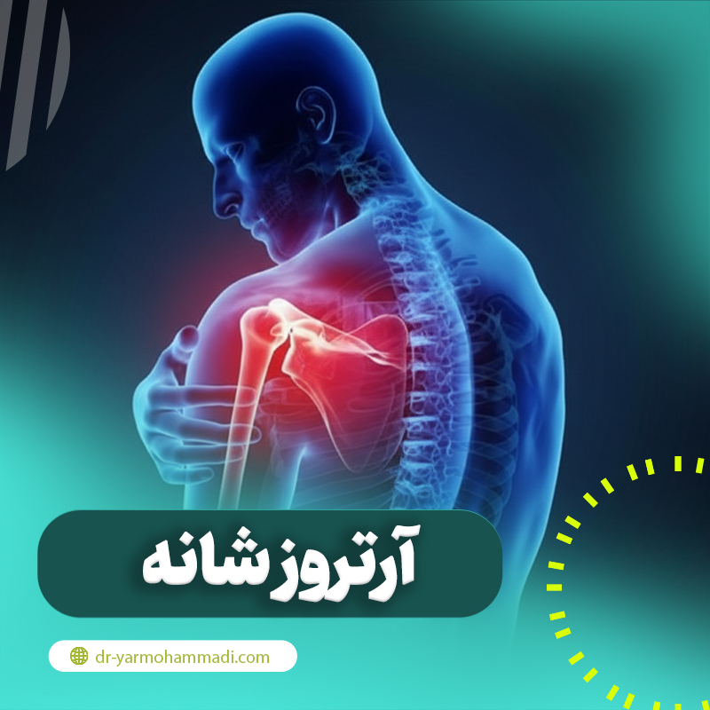 آرتروز شانه چیست و چگونه درمان می شود؟